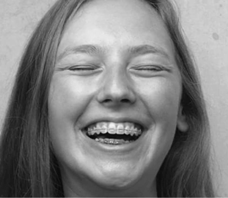 young patient wearing traditional metal braces